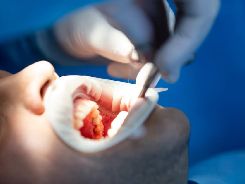 painless root canal treatment in Dwarka