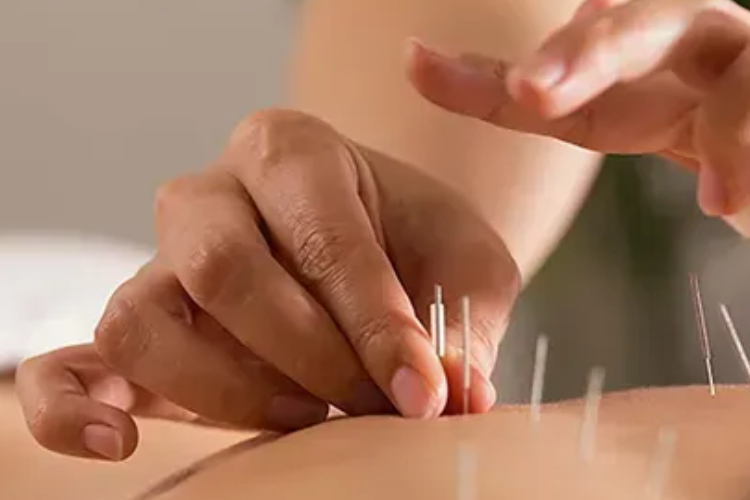 Acupuncture therapist clifton nj