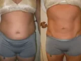 cool sculpting cost stomach
