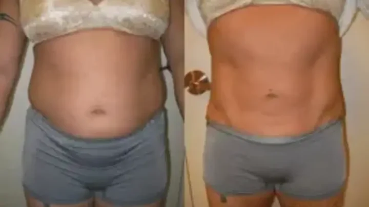 Unveiling The True Cool Sculpting Cost For A Toned Stomach