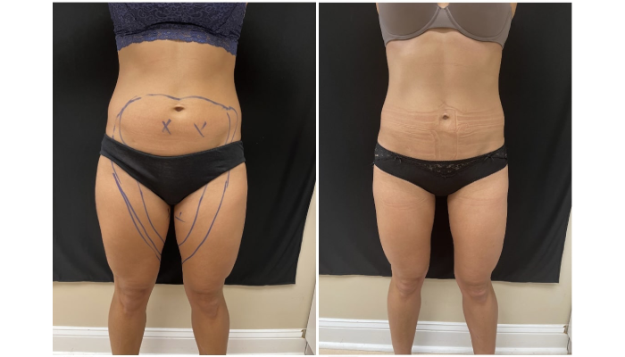 Liposuction For Men: Why It’s Growing In Popularity And What To Know?