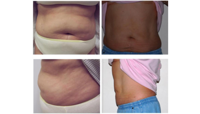 How To Choose The Right Liposuction Surgeon For Safe And Effective Results?