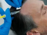 Sapphire hair transplant in Turkey